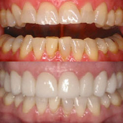 Before and after photos of dental work