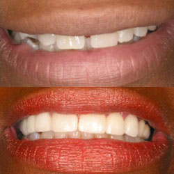 Before and after photos of dental work