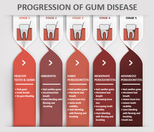 Chart showing progression of gum disease after symptoms of swollen bleeding gums.