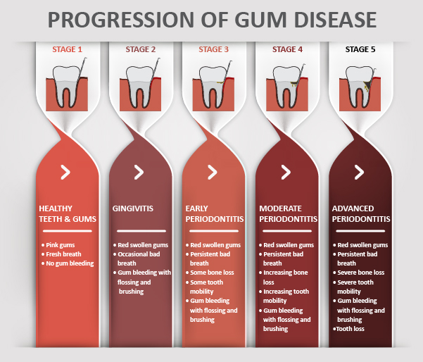 Progression of gum disease chart with symptoms of swollen bleeding gums.